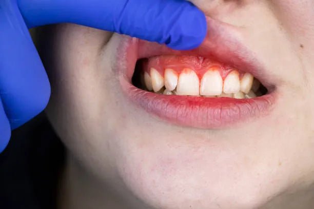 Remèdes Naturels Pour Traiter La Récession Gingivale – Guide 2026