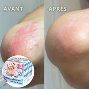 Crème Anti - Psoriasis 80g | Soulagement et Hydratation Naturelle - nilabeautys.com
